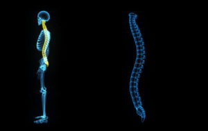 Spinal Cord Stimulation Treatement